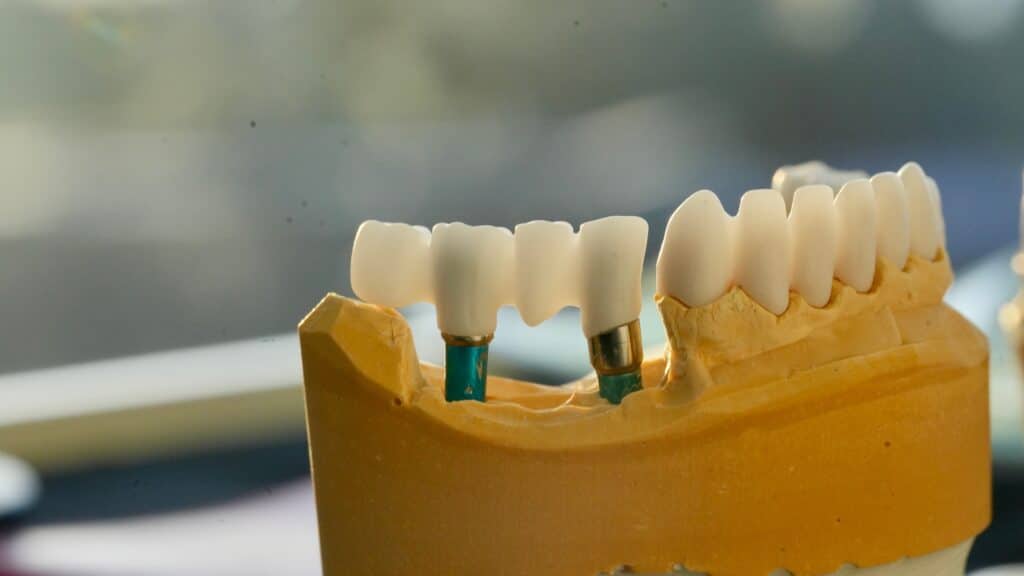 Dentures vs Mini Dental Implant-Supported Dentures Louisville