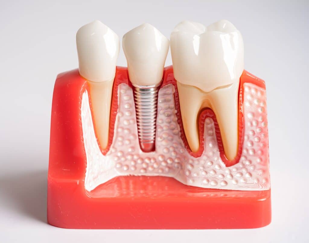 Healing Time After Tooth Extraction and Mini Implant